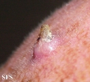 keratoacanthoma
