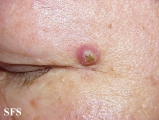 keratoacanthoma