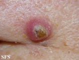 keratoacanthoma