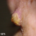 keratoacanthoma