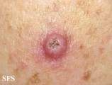keratoacanthoma