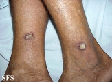 keratoacanthoma