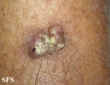 keratoacanthoma