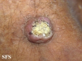 keratoacanthoma