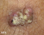 keratoacanthoma