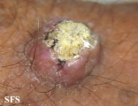 keratoacanthoma