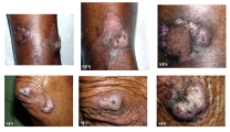 keratoacanthoma