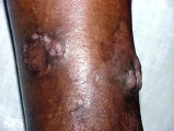 keratoacanthoma