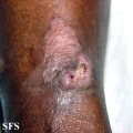 keratoacanthoma