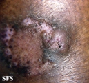 keratoacanthoma