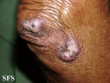 keratoacanthoma