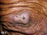 keratoacanthoma