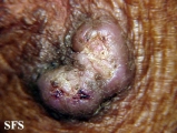 keratoacanthoma