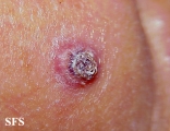 keratoacanthoma