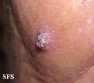keratoacanthoma