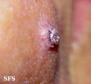 keratoacanthoma