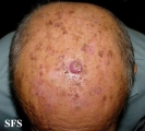 keratoacanthoma