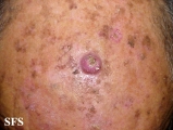 keratoacanthoma