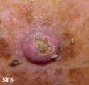 keratoacanthoma