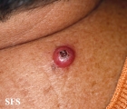 keratoacanthoma