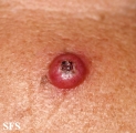 keratoacanthoma