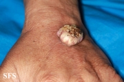 keratoacanthoma