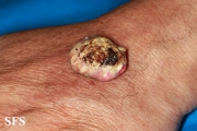 keratoacanthoma
