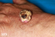 keratoacanthoma