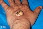 keratoacanthoma