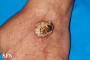 keratoacanthoma