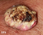keratoacanthoma