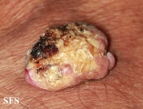 keratoacanthoma