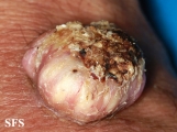 keratoacanthoma