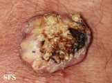 keratoacanthoma