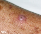keratoacanthoma
