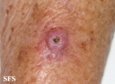 keratoacanthoma