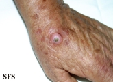 keratoacanthoma