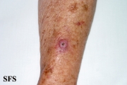 keratoacanthoma