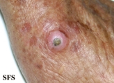 keratoacanthoma