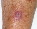 keratoacanthoma