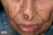 keratoacanthoma
