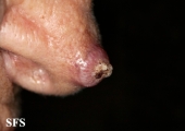 keratoacanthoma