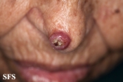 keratoacanthoma