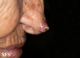 keratoacanthoma