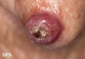 keratoacanthoma