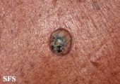 keratoacanthoma