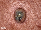 keratoacanthoma