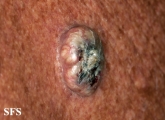 keratoacanthoma
