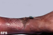 stasis eczema and leprosy tuberculoid