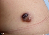 dermatofibrosarcoma protuberans